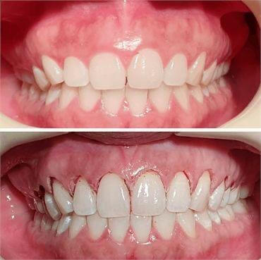 جراحة تجميلية للثة باستخدام الليزر